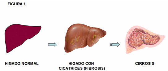 el alcohol cómo afecta al hígado hepatitis alcohólica