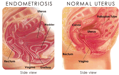 education-endometriosis